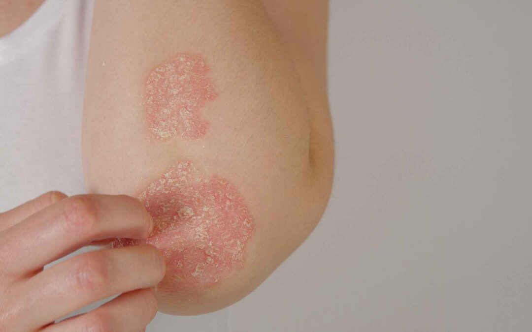 What is Psoriasis? – Causes and Management Strategies