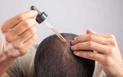 Minoxidil for Hair Loss