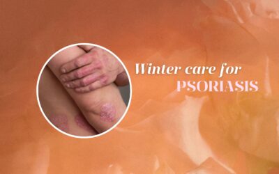 PSORIASIS IN WINTER AND ITS MANAGEMENT