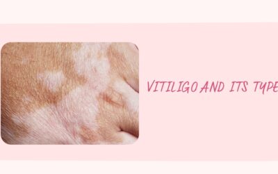 VITILIGO AND ITS TYPES