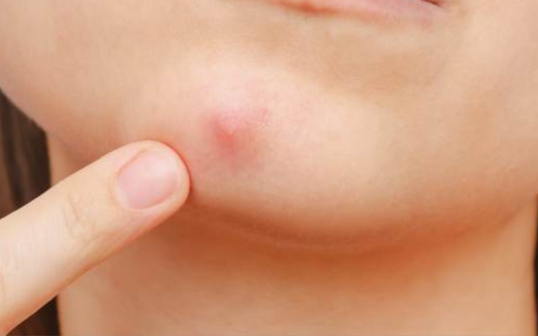 POP THE KNOWLEDGE, NOT THE PIMPLES!